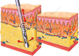 Darstellungen Fettabsaugung (Liposuktion) der Haut mit Cellulite